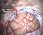 Hemispheric cerebellar astrocytoma 