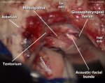 Petroclival meningioma 1