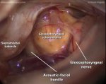 Glossopharyngeal schwannoma (Right-retrosigmoid approach)