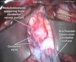 Medulloblastoma 