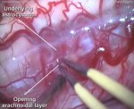 Cervical intramedullary astrocytoma 