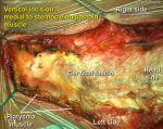 Cervical solitary plasmocytoma - extirpation