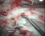 Cervical intramedullary teratoma 