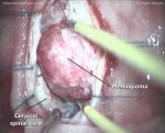 Cervical meningioma - extirpation