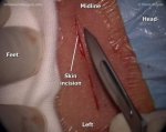 Cervical microdiscectomy