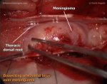 Thoracic meningeoma - extirpation