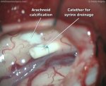 Syringomyelia