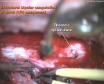 Thoracic dural AVM